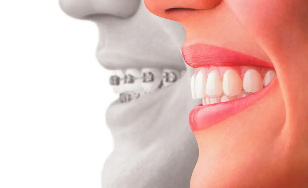 l'ostéopathie peut diminuer les effets indésirables de l'orthodontie et du traitement orthodontique